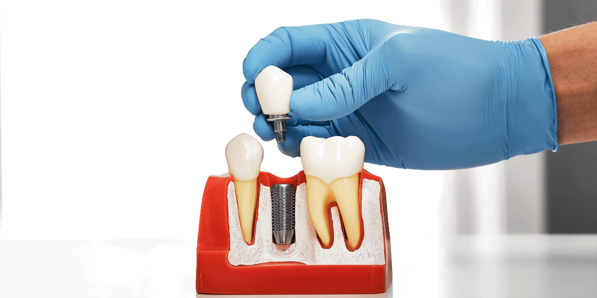 Dental Implants A Comprehensive Guide In 2024 Fahim Joharder   Untitled Design 22 